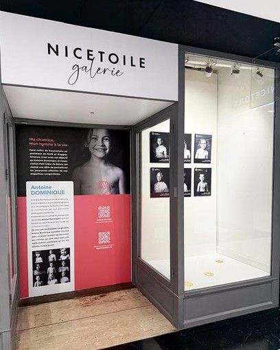 Ma cicatrice, mon hymne à la vie - Associazione Petit Cœur de Beurre e il fotografo Antoine Dominique - Nicetoile Ma cicatrice, mon hymne à la vie - Associazione Petit Cœur de Beurre e il fotografo Antoine Dominique - Nicetoile