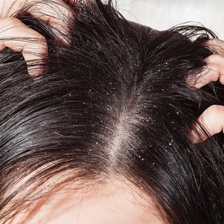 5 migliori shampoo antiforfora del 2024