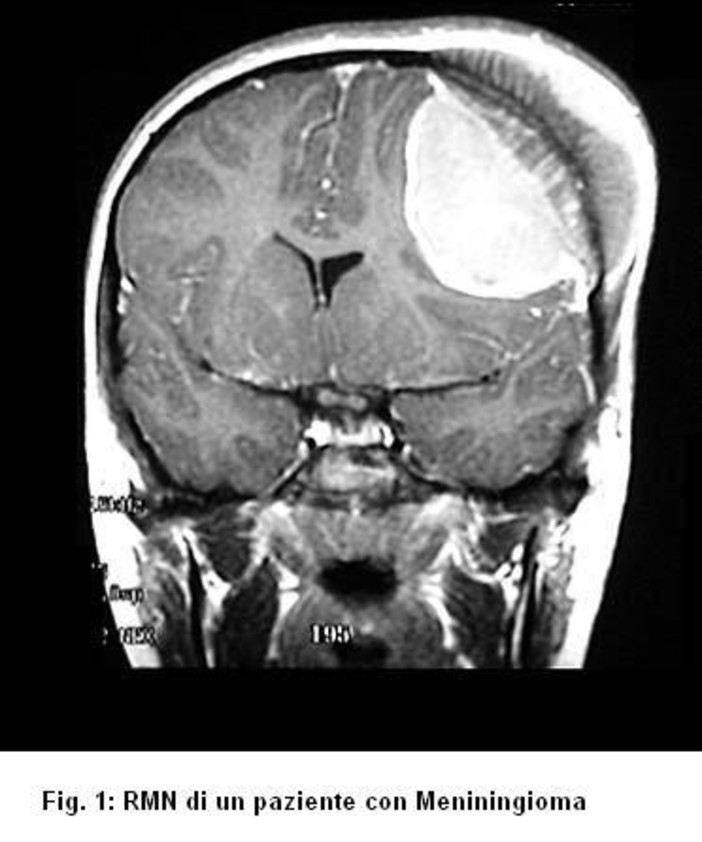 Che cos’è un Meningioma? Sintomi, conoscenza e cure Che cos’è un Meningioma? Sintomi, conoscenza e cure