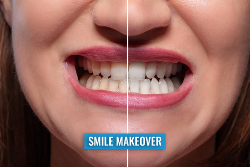 La rivoluzione dello Smile Makeover: l'eccellenza estetica e funzionale dell'odontoiatria moderna