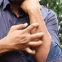 Studio Novartis, l’orticaria cronica spontanea costa 4.200 euro l’anno a paziente
