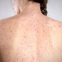 Morbillo, è allarme negli Usa. Italia prima per casi in Europa in in primi 6 mesi 2026 Morbillo, è allarme negli Usa. Italia prima per casi in Europa in in primi 6 mesi 2026