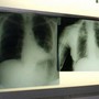 Cancro polmone, con nuova combinazione malattia sotto controllo più a lungo