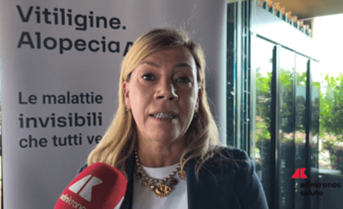 Cordella (AbbVie): "Vitiligine e alopecia siano riconosciute da Ssn"