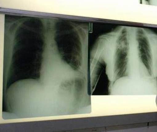 Cancro polmone, con nuova combinazione malattia sotto controllo più a lungo Cancro polmone, con nuova combinazione malattia sotto controllo più a lungo