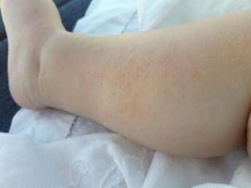 Dermatite atopica, Aifa estende rimborso di upadacitinib dai 12 anni di età Dermatite atopica, Aifa estende rimborso di upadacitinib dai 12 anni di età