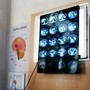 Di Battista, cosa indica un mal di testa forte e improvviso: le ipotesi del neurologo
