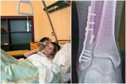 Thais Wiggers, operazione alla caviglia dopo incidente: "Comincio anno con un piede bionico" Thais Wiggers, operazione alla caviglia dopo incidente: "Comincio anno con un piede bionico"