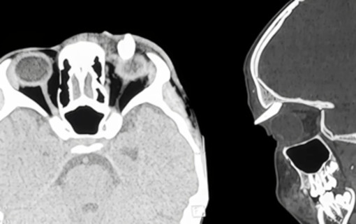 Ha un gonfiore sotto l'occhio, in ospedale scoprono che ha un dente nella palpebra: lo strano caso in India