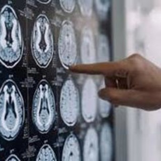 Malattia di Parkinson, ok in Europa a formulazione orale Ld/Cd a rilascio modificato Malattia di Parkinson, ok in Europa a formulazione orale Ld/Cd a rilascio modificato