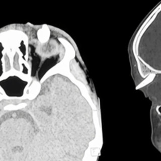 Ha un gonfiore sotto l'occhio, in ospedale scoprono che ha un dente nella palpebra: lo strano caso in India Ha un gonfiore sotto l'occhio, in ospedale scoprono che ha un dente nella palpebra: lo strano caso in India