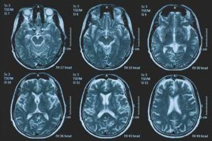 Una persona su 3 ha un disturbo neurologico, a Napoli arriva BrainSpace House Una persona su 3 ha un disturbo neurologico, a Napoli arriva BrainSpace House