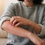 Malattia della pioggia, perché se ne parla: cos'è e sintomi Malattia della pioggia, perché se ne parla: cos'è e sintomi